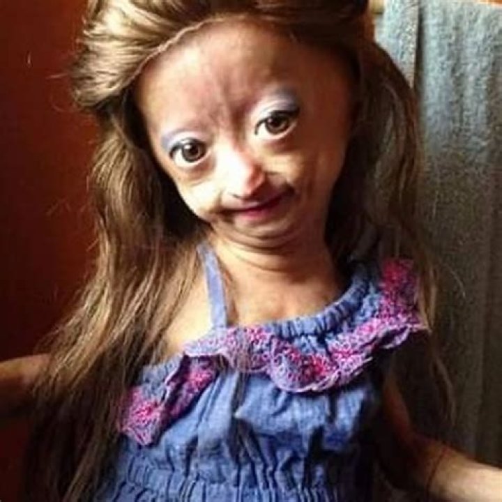 Adalia Rose Bio (Wiki) 