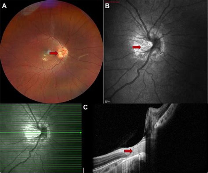 Can optic nerve hypoplasia get worse?