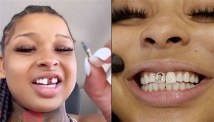 Chrisean Rock’s Missing Tooth: What Really Happened