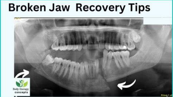 How do you sleep with a broken jaw?