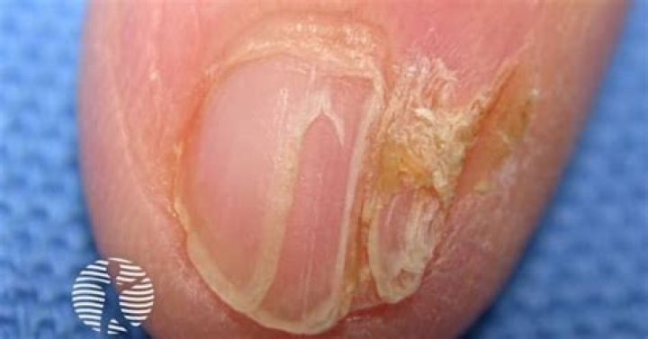 How do you treat pterygium nails?