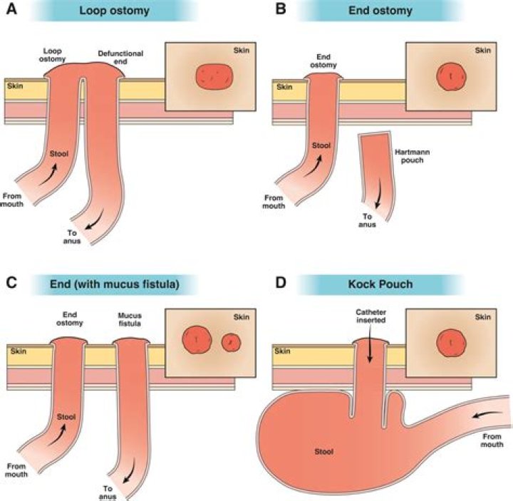 How long can a stoma blockage last?