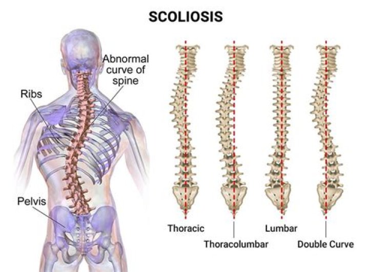 How serious is Levoscoliosis?