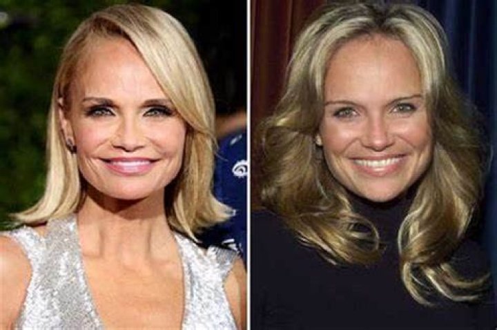 Kristin Chenoweth Botox