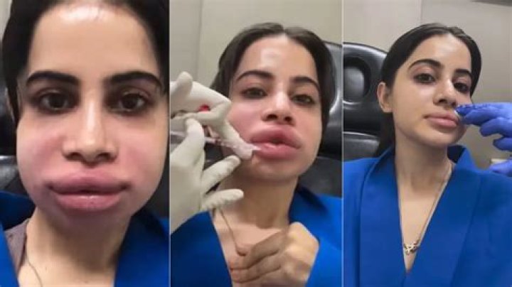 Urfi Javed Plastic Surgery
