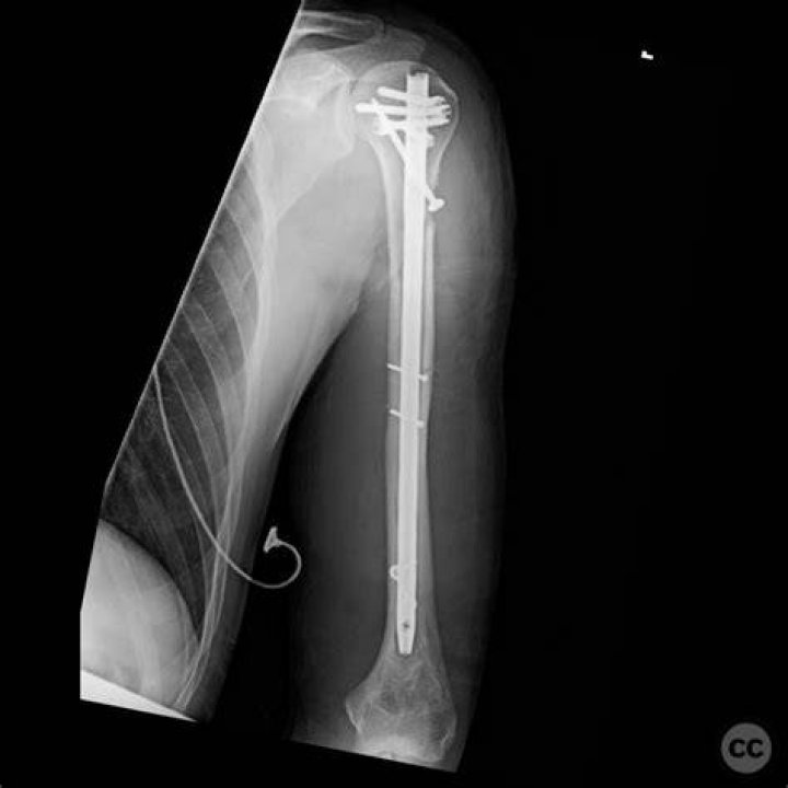 What causes a butterfly fracture?