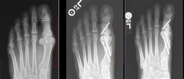 What is the CPT code for Akin osteotomy?