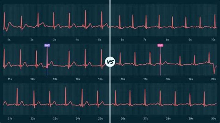 What is the difference between PAC and PJC?