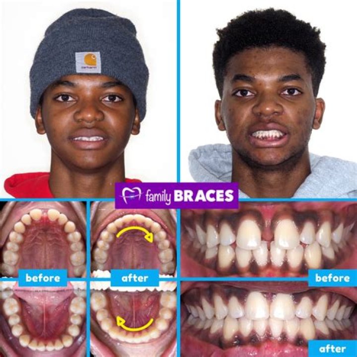 
What Is Wrong With Buddy Hield Teeth? Used Braces Or Teeth Whitening 