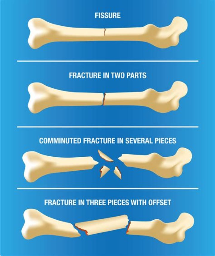 What type of fracture involves a bone breaking and splintering into pieces?